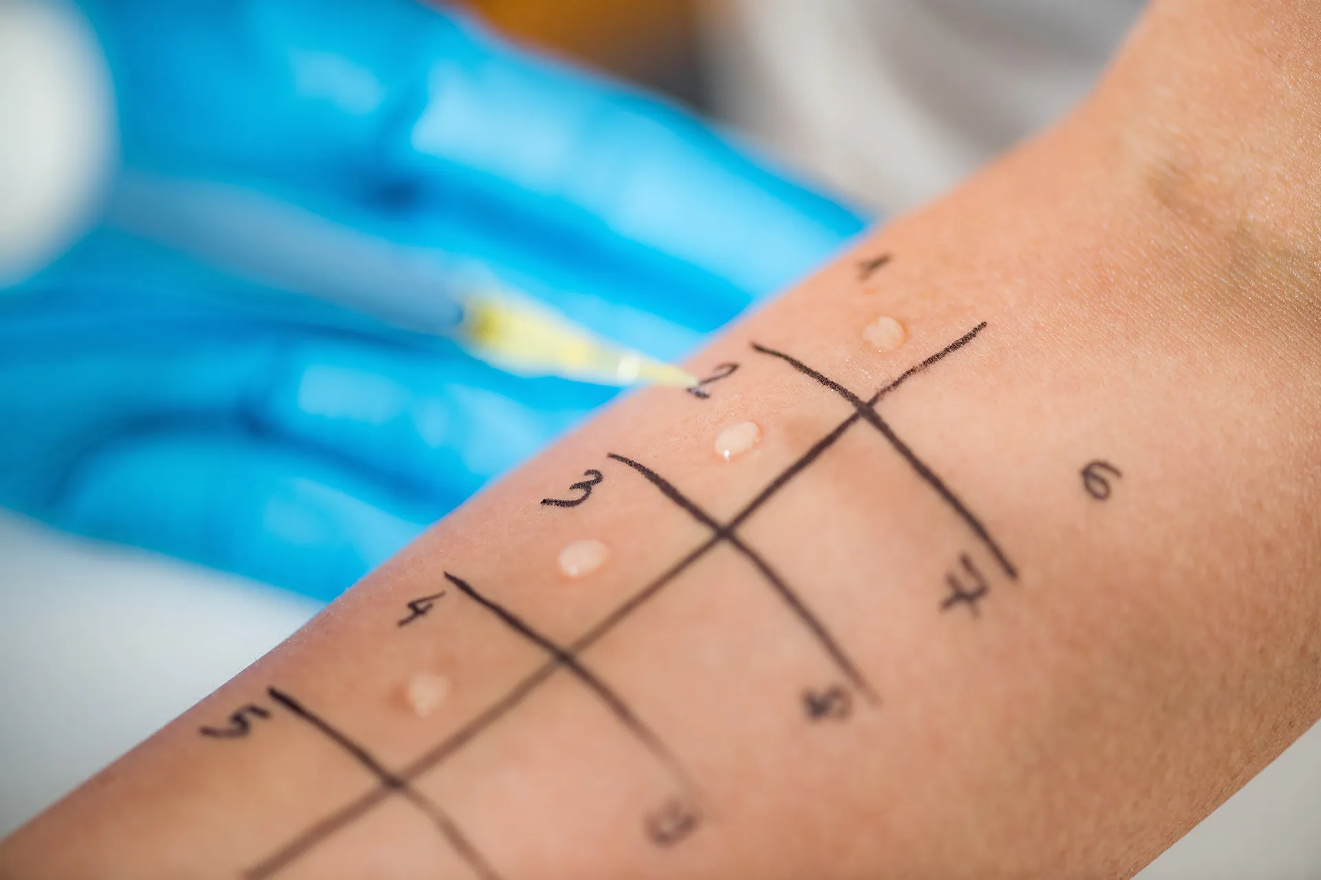 Pricktest am Unterarm mit nummerierten Feldern und Allergenlösungen – Allergietest zur Abklärung von Heuschnupfen